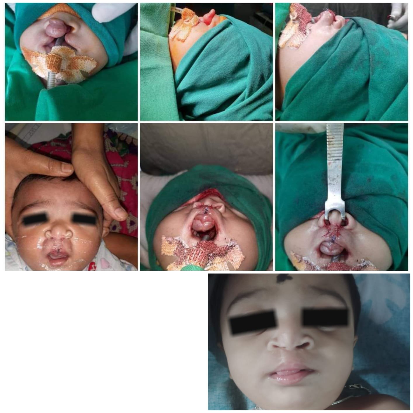 bilateral cleft lip repair